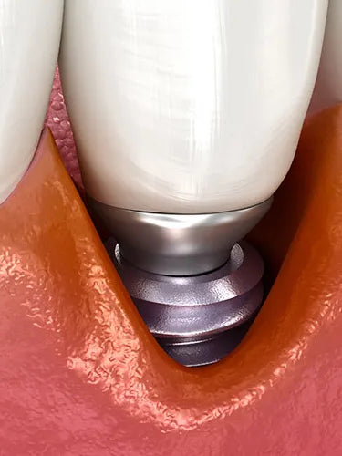 Periimplantitis: Was tun gegen Entzündungen rund um ein Implantat?