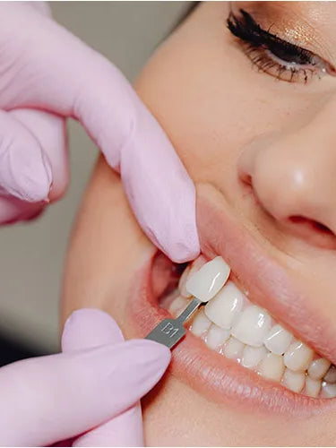 Veneers: Alles, was du wissen musst