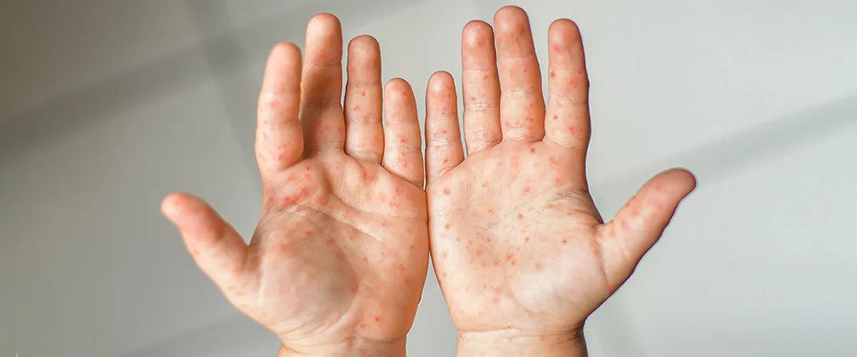 Was ist die Hand-Fuss-Mund-Krankheit und was kann man dagegen tun?