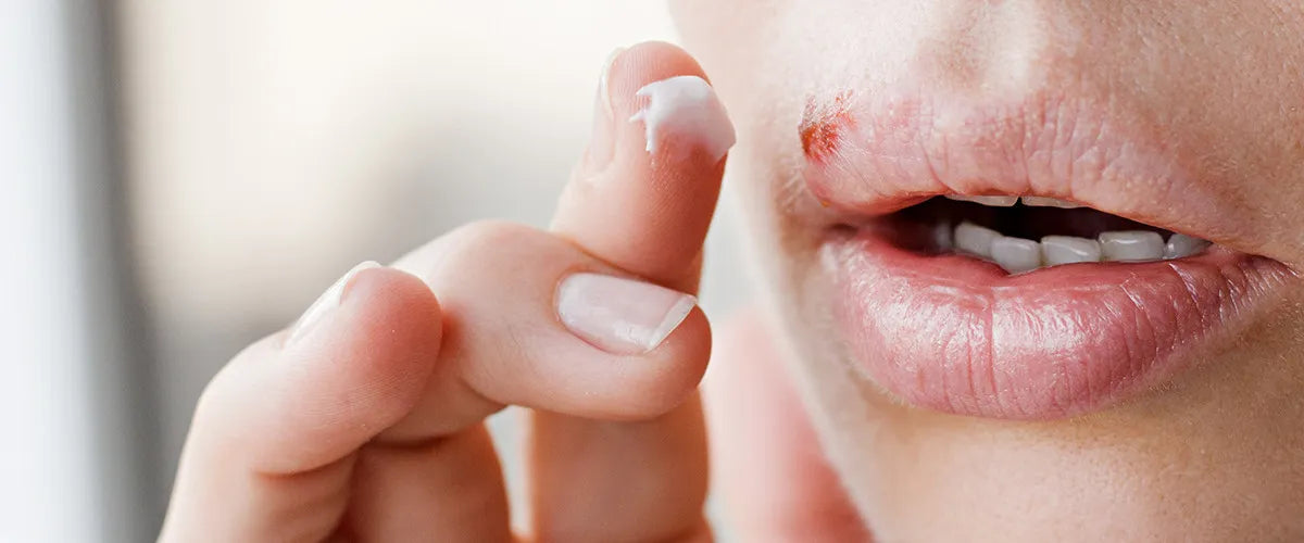 Was ist Lippenherpes und was kann man dagegen tun?