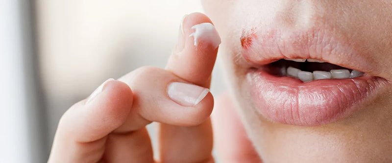 Was ist Lippenherpes und was kann man dagegen tun?