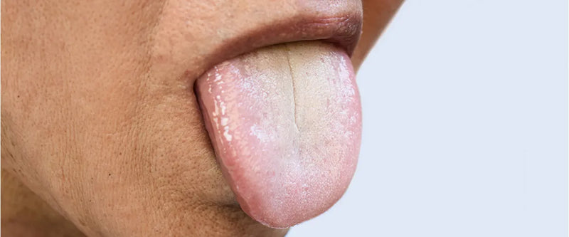 Orale Leukoplakie: Warum sie gefährlich sein kann