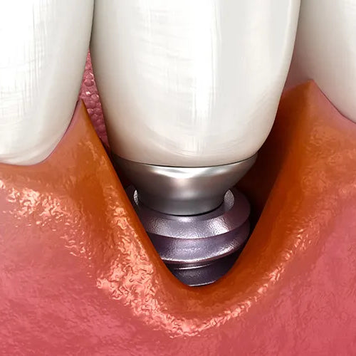 Periimplantitis: Was tun gegen Entzündungen rund um ein Implantat?