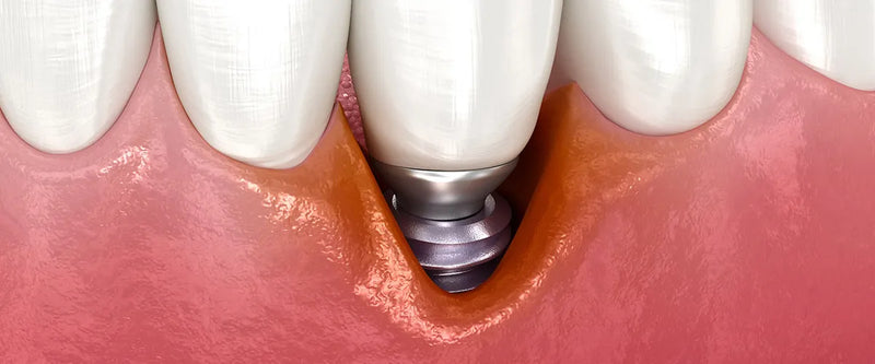 Periimplantitis: Was tun gegen Entzündungen rund um ein Implantat?
