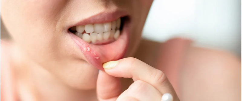 Stomatitis: Was hilft bei einer Entzündung der Mundschleimhaut?