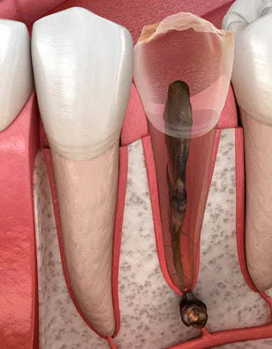 Zahnwurzelentzündung: Alles über Symptome und Behandlung der Pulpitis