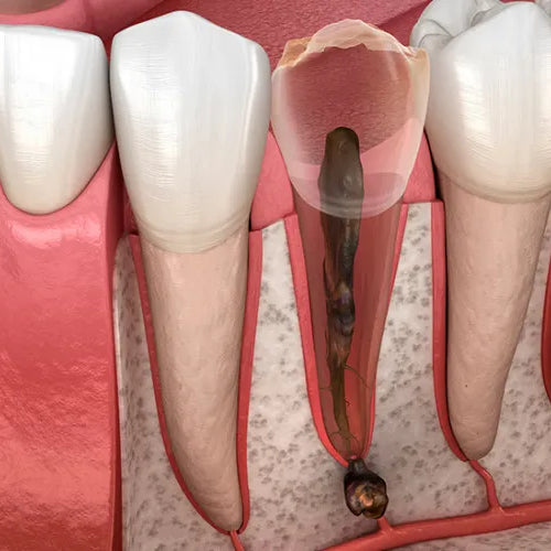 Zahnwurzelentzündung: Alles über Symptome und Behandlung der Pulpitis