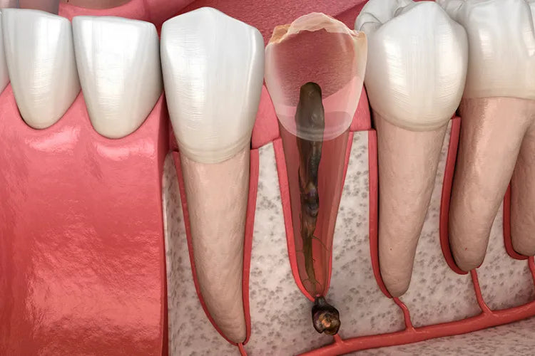 Zahnwurzelentzündung: Alles über Symptome und Behandlung der Pulpitis