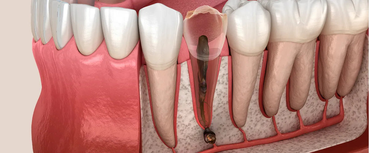 Zahnwurzelentzündung: Alles über Symptome und Behandlung der Pulpitis