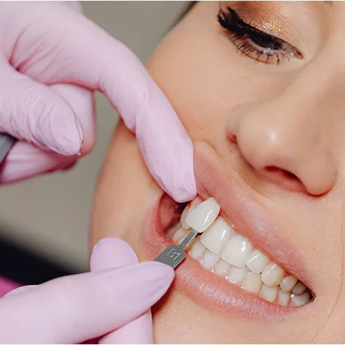 Veneers: Alles, was du wissen musst