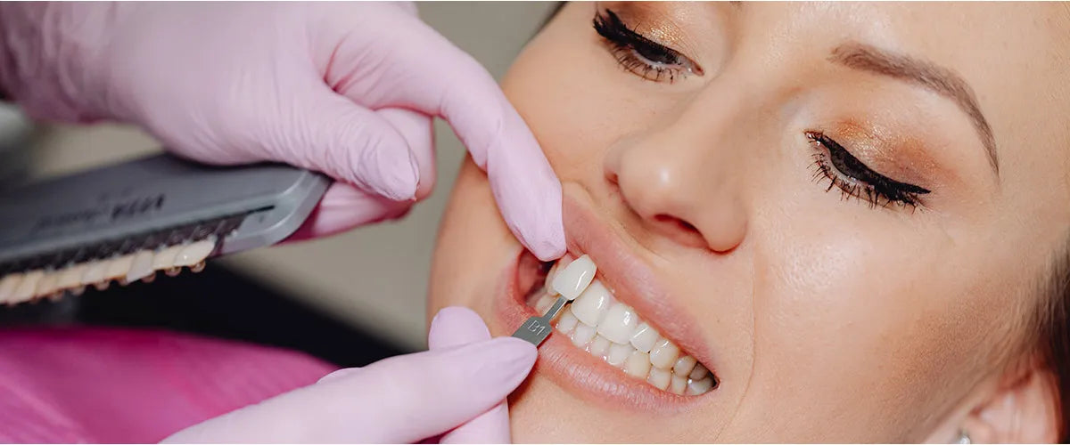 Veneers: Alles, was du wissen musst