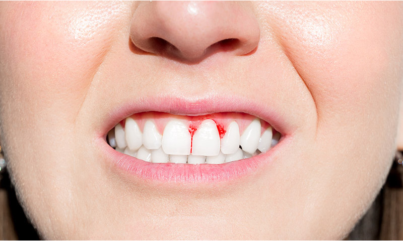 How to combat bleeding gums