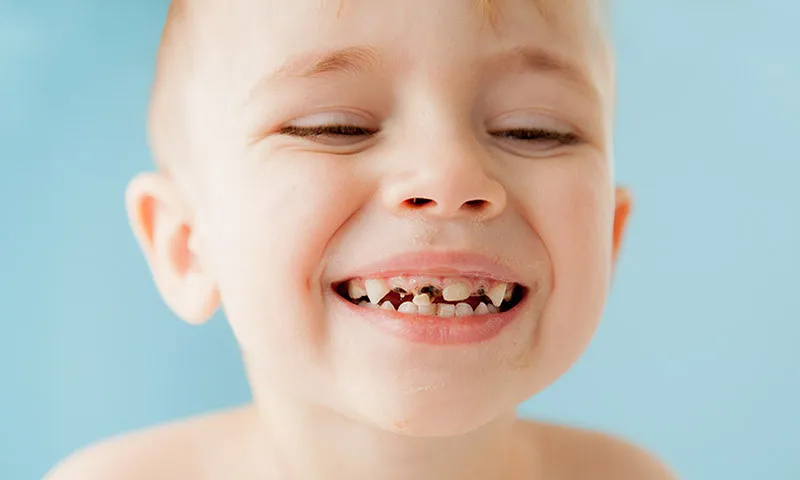 Caries: Treatment and prevention