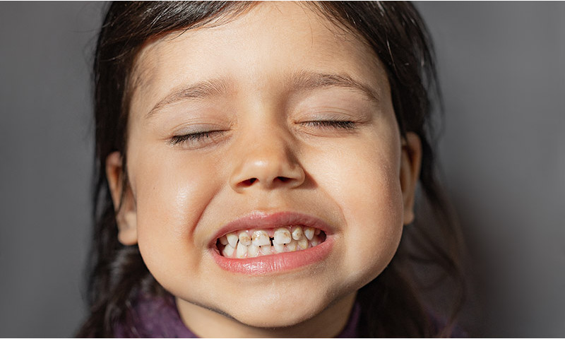 What are chalky teeth and what can you do about them?