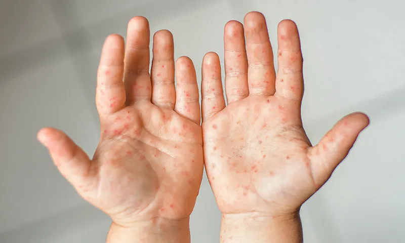 What is hand, foot and mouth disease and what can you do to prevent it?