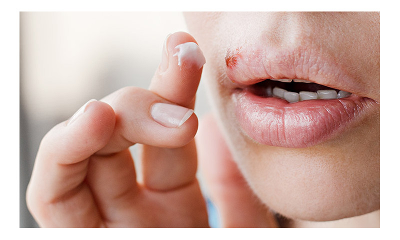 What are cold sores and what can you do about them?