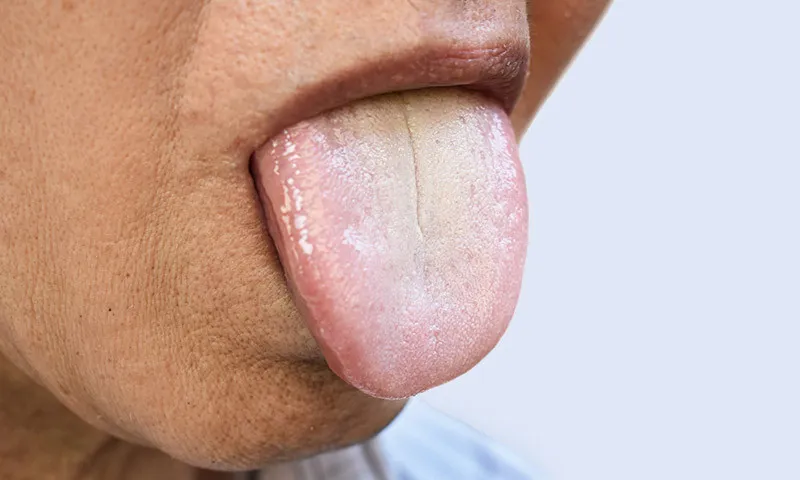 Oral leukoplakia: why it can be dangerous