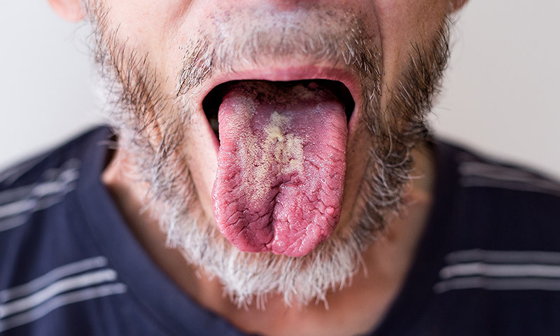 Oral thrush: Everything you need to know about the fungal infection of the mouth