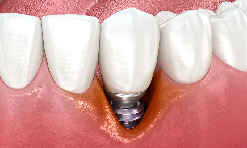 Peri-implantitis: What to do about inflammation around an implant?