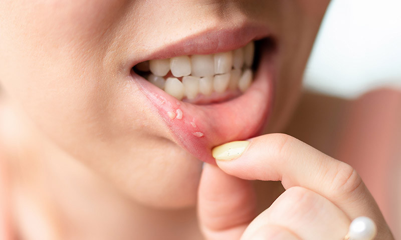 Stomatitis: What helps with inflammation of the oral mucosa?