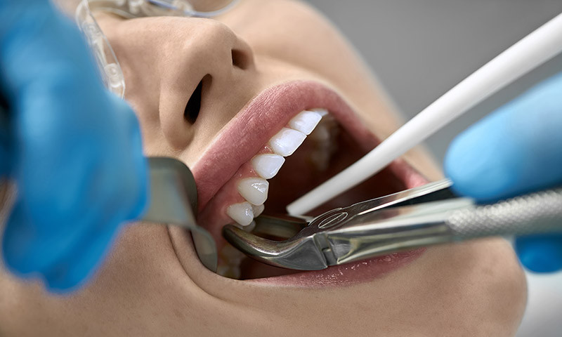 Tooth extraction: What you need to know