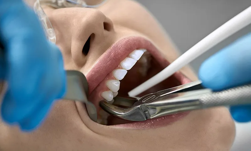 Tooth extraction: What you need to know