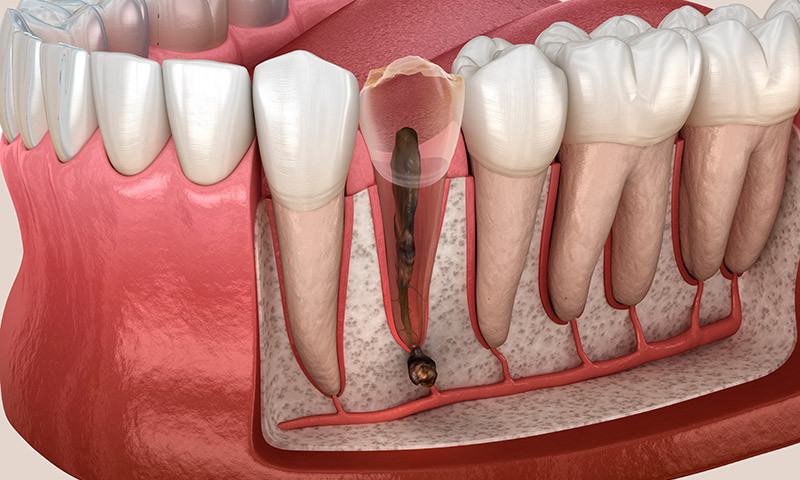 Tooth root inflammation: All about the symptoms and treatment of pulpitis